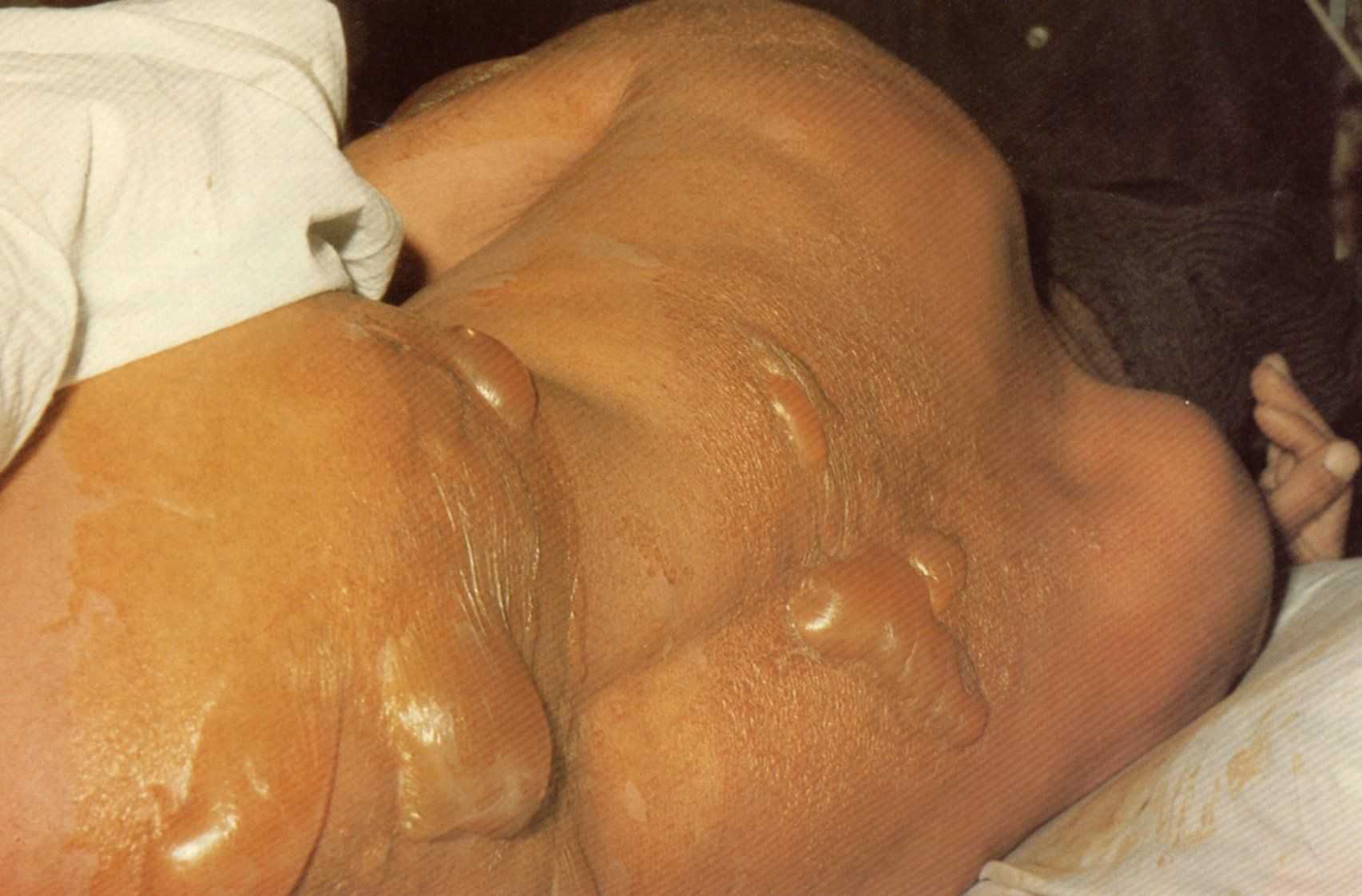 Photograph showing the back of a person affected by mustard agent exposure, with large blisters visible on the skin.